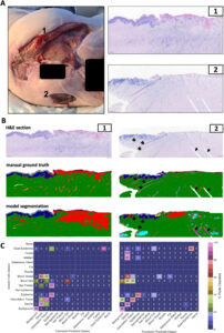 A biopsy image of a complex wound analsis by AI, showing segmented tissue types like epidermis, dermis, and necrosis.