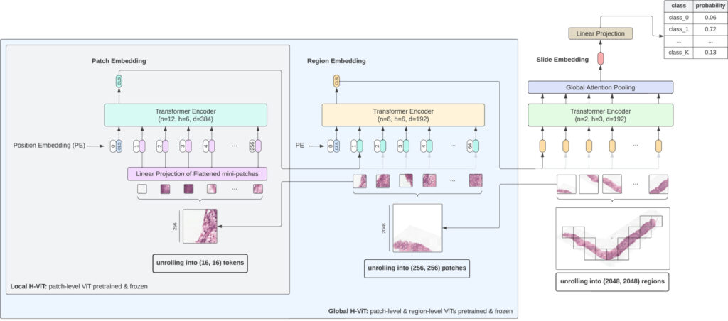 Hierarchical Vision Transformers (H-ViT) enhancing prostate cancer grading accuracy through AI-driven pathology analysis