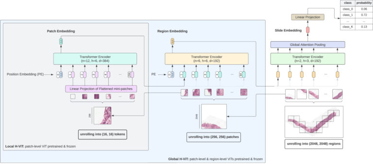 Hierarchical Vision Transformers (H-ViT) enhancing prostate cancer grading accuracy through AI-driven pathology analysis