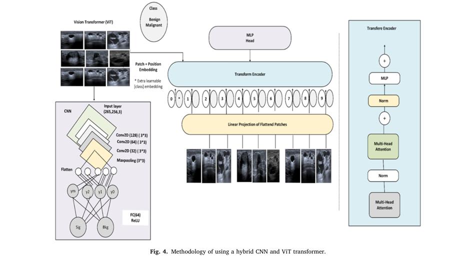 Hybrid CNN-ViT model analyzing breast ultrasound images from the KAUH-BCUSD dataset, achieving 95.12% classification accuracy.”