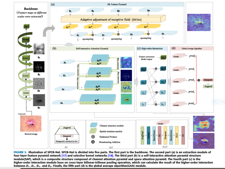 Illustration of SPCB-Net architecture showing SK feature pyramid, SAP attention module, and bilinear-trilinear pooling layers for skin cancer detection"