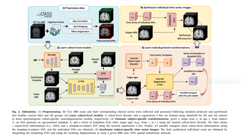 Simulation of individualized brain aging and Alzheimer’s progression using AI with diffeomorphic registration