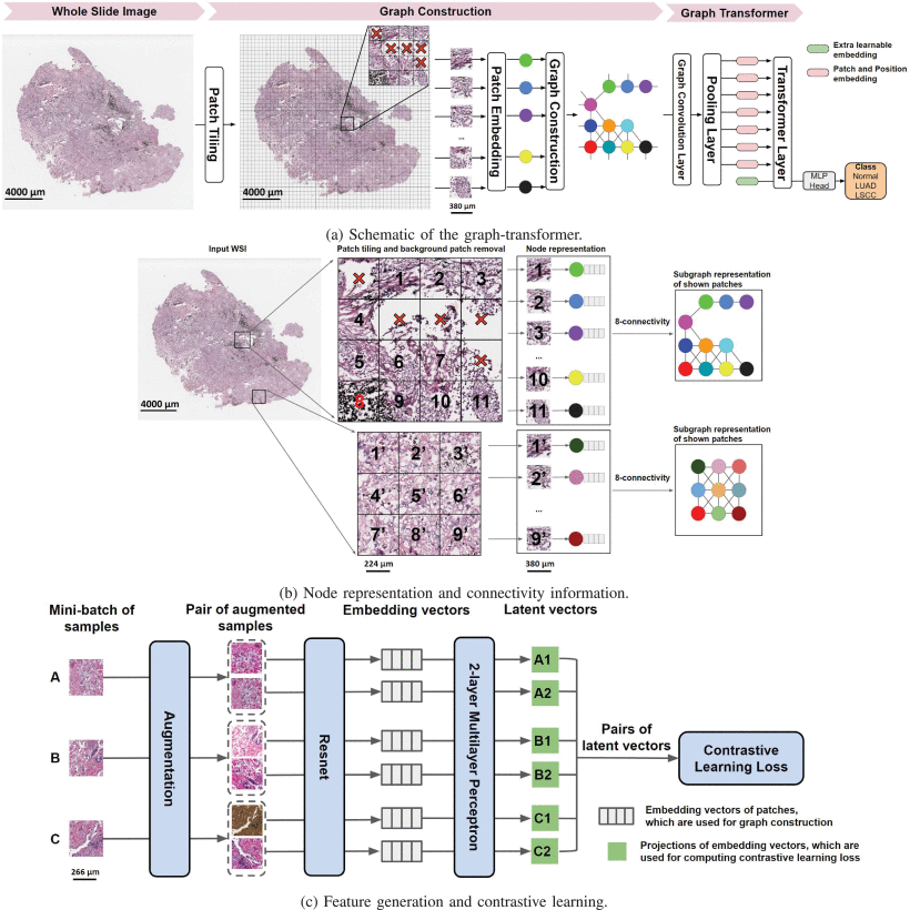 Infographic showing the GTP framework: WSI → Patch Embedding → Graph Transformer → Classification