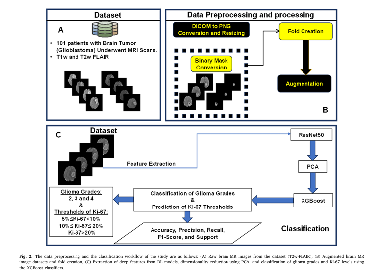 AI-powered glioma grading using ResNet50, SHAP analysis, and XGBoost for non-invasive brain tumor grading and Ki-67 prediction in MRI scans