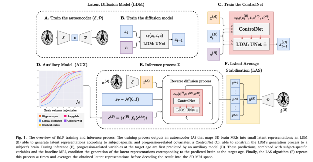 AI-generated 3D brain MRI progression map showing neurodegeneration over time, highlighting regions like hippocampus and ventricles with color-coded atrophy levels.