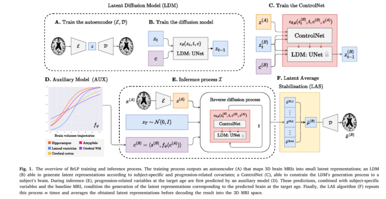 AI-generated 3D brain MRI progression map showing neurodegeneration over time, highlighting regions like hippocampus and ventricles with color-coded atrophy levels.