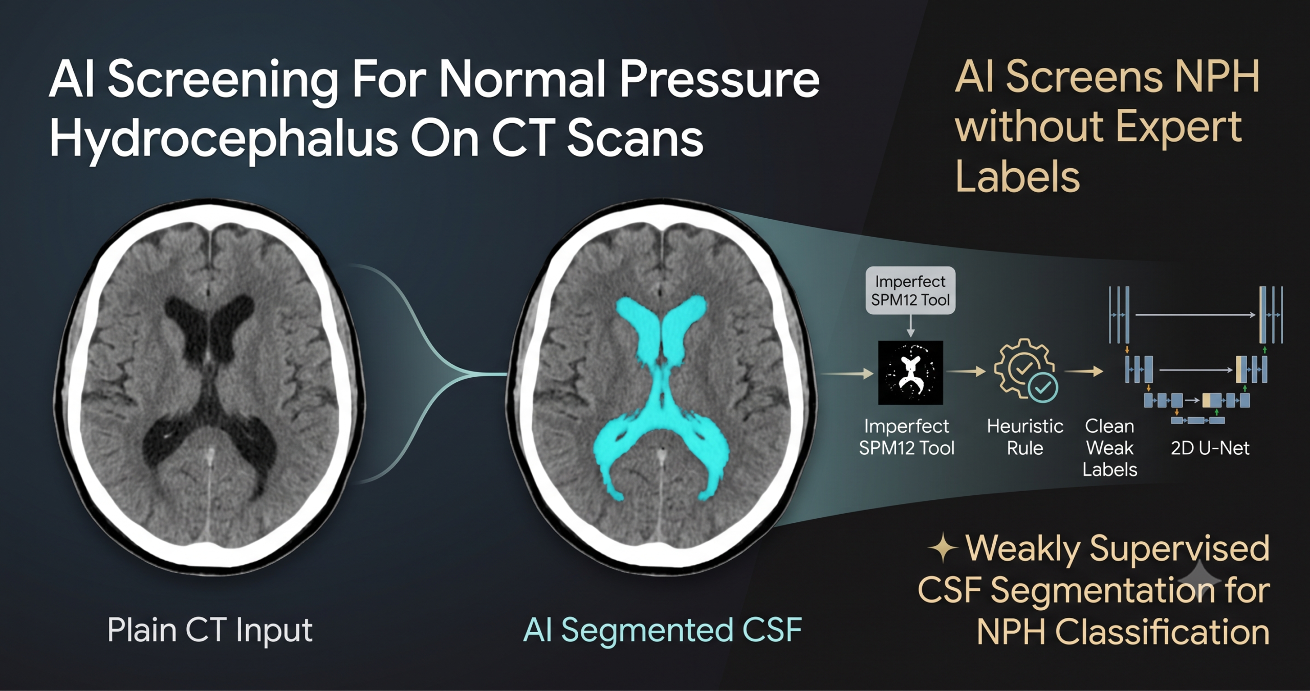 Brain CT scan with cerebrospinal fluid regions highlighted, illustrating an AI model screening for normal pressure hydrocephalus