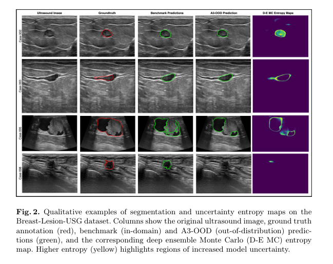 AI-generated segmentation of a breast ultrasound image with overlay uncertainty heatmap showing high confidence (blue) and low confidence (yellow) regions near tumor boundaries for breast tumor segmentation.
