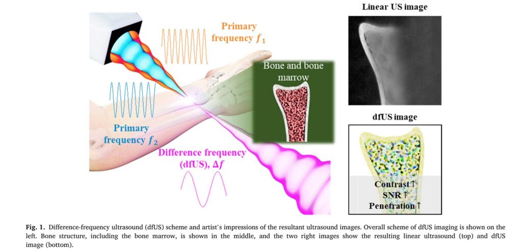 Revolutionizing Medical Imaging: How a Compact, Programmable Ultrasound Array Unlocks High-Contrast Elastography for Bones and Tumors