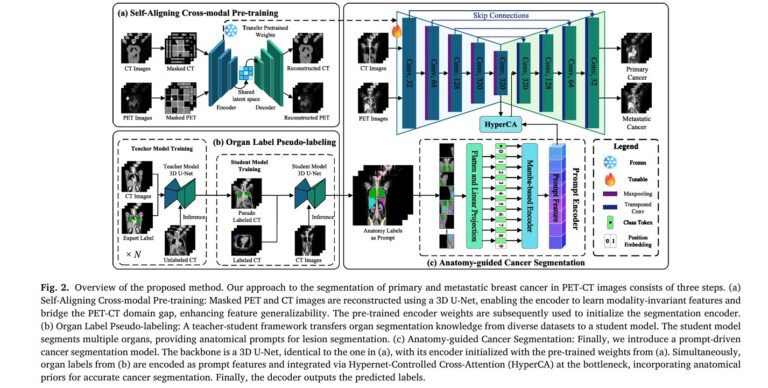 Anatomy-Guided Deep Learning Is Transforming Breast Cancer Detection in PET-CT Scans