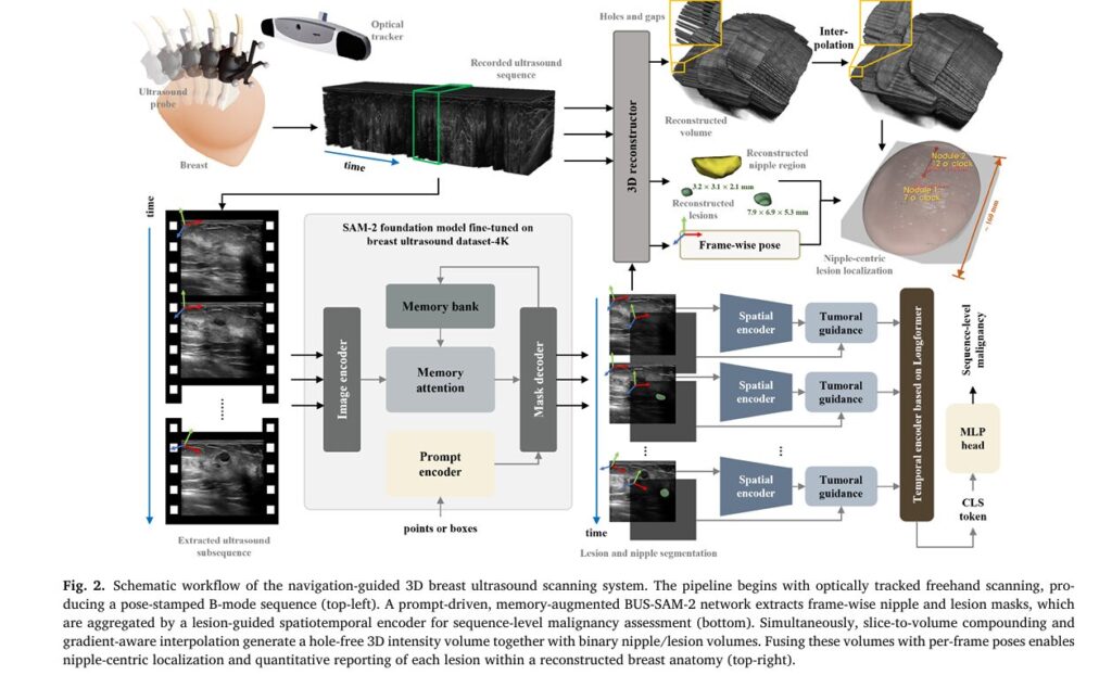 Revolutionizing Breast Cancer Detection: How AI-Powered 3D Ultrasound Navigation Is Transforming Early Diagnosis
